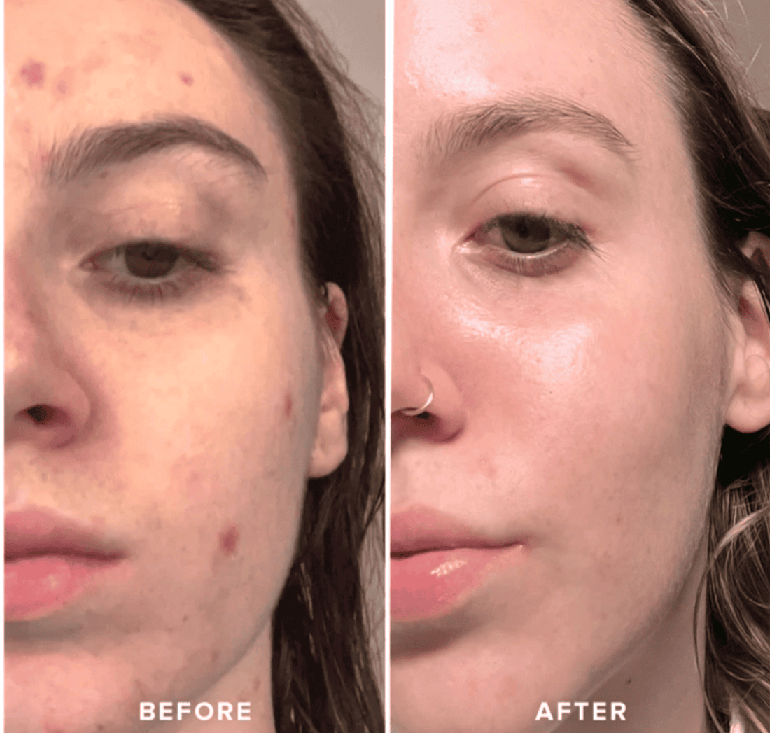 Face Ice Roller | Facial Massage
